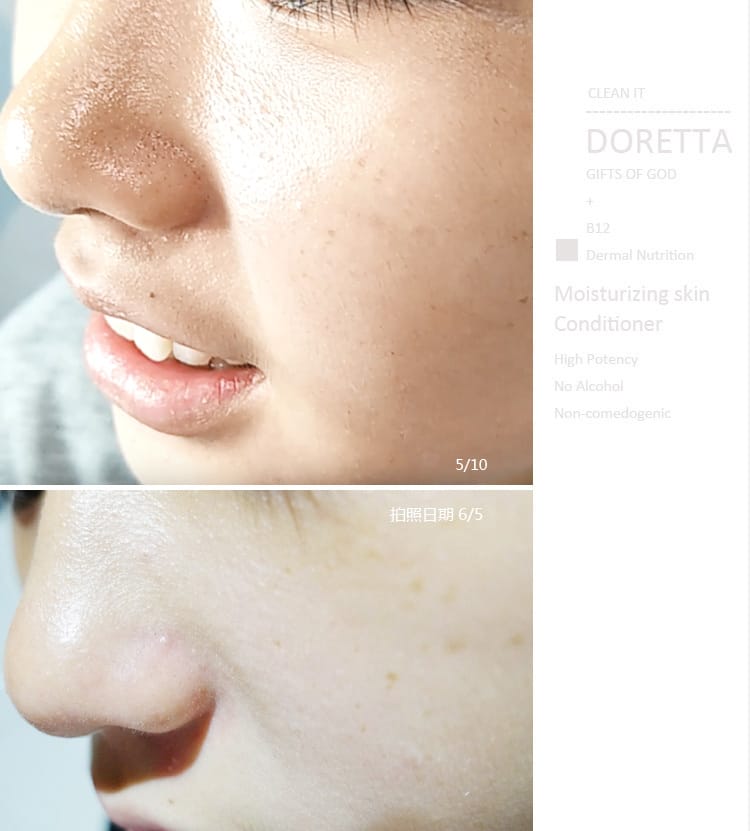 【保養】DORETTA朵芮:去粉刺用洗的就行 ~毛孔角栓潔顏布+潔膚慕斯 ” 三天就讓黑頭粉刺Out~ - 第25張圖 【保養】DORETTA朵芮:去粉刺用洗的就行 ~毛孔角栓潔顏布+潔膚慕斯 ” 三天就讓黑頭粉刺Out~